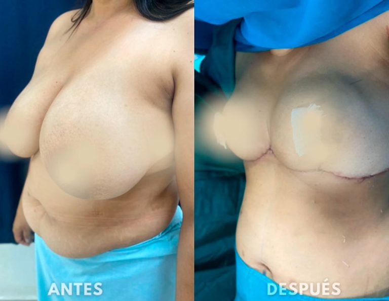 Post-operatorio inmediato