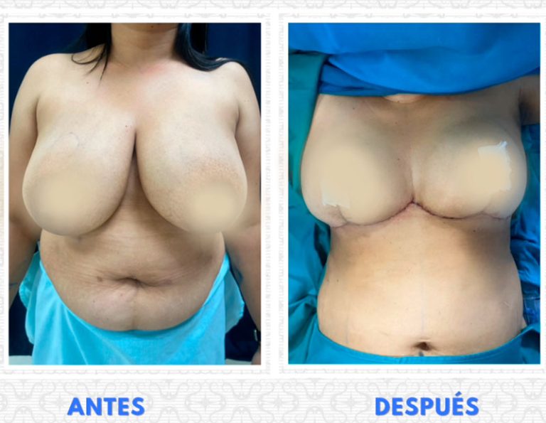 Post-operatorio inmediato