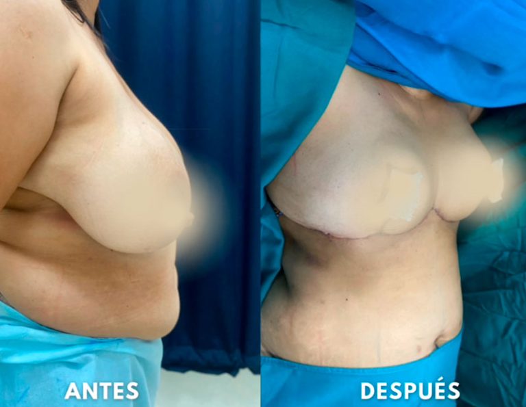 Post-operatorio inmediato