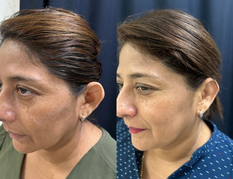 Post-operatorio (60 días)