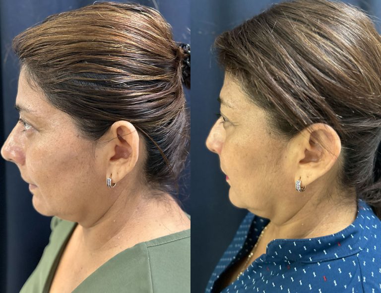 Post-operatorio (60 días)