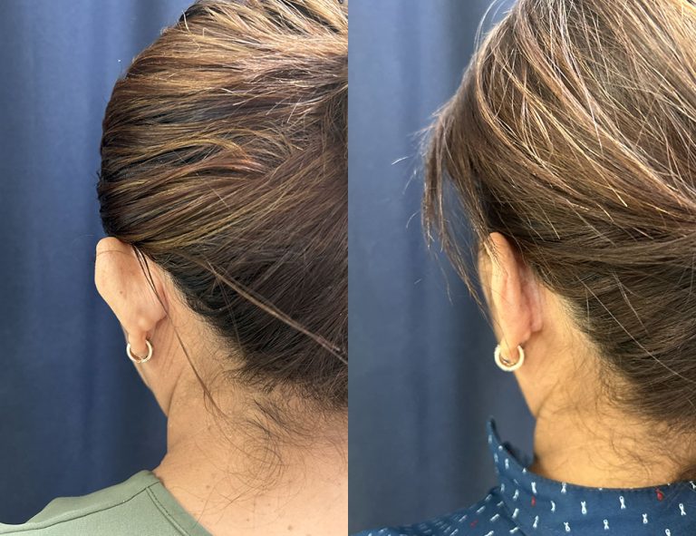 Post-operatorio (60 días)