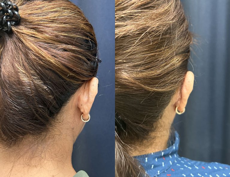 Post-operatorio (60 días)