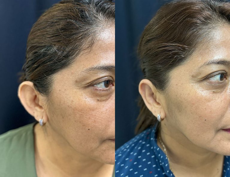 Post-operatorio (60 días)