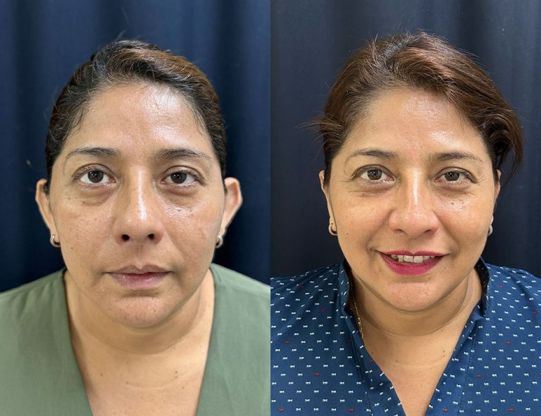 Post-operatorio (60 días)