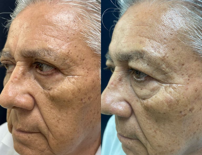 Post-operatorio (60 días)