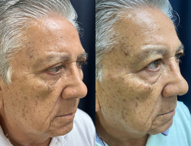 Post-operatorio (60 días)