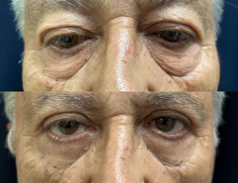 Post-operatorio (60 días)