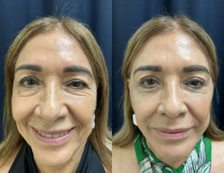 Lifting de Cara y Cuello + Blefaroplastia. 60 días Postoperatorio (Antes y Después)