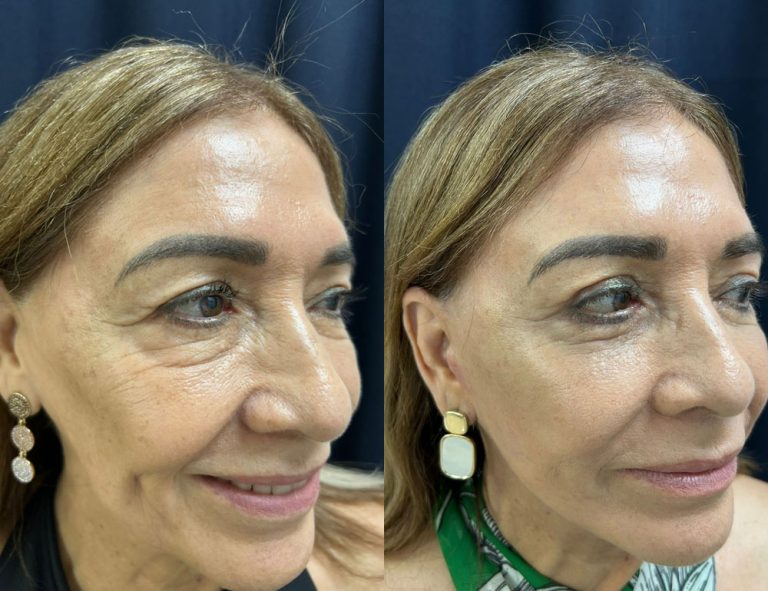 Lifting de Cara y Cuello + Blefaroplastia. 60 días Postoperatorio (Antes y Después)