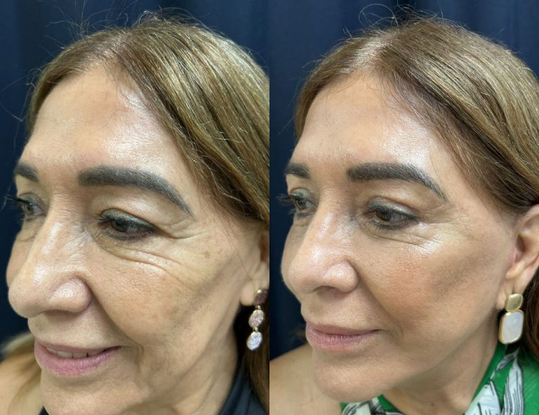 Lifting de Cara y Cuello + Blefaroplastia. 60 días Postoperatorio (Antes y Después)