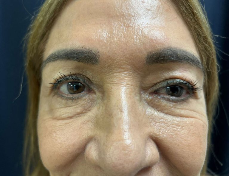 Lifting de Cara y Cuello + Blefaroplastia. 60 días Postoperatorio (Antes)