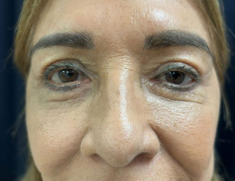 Lifting de Cara y Cuello + Blefaroplastia. 60 días Postoperatorio (Después)