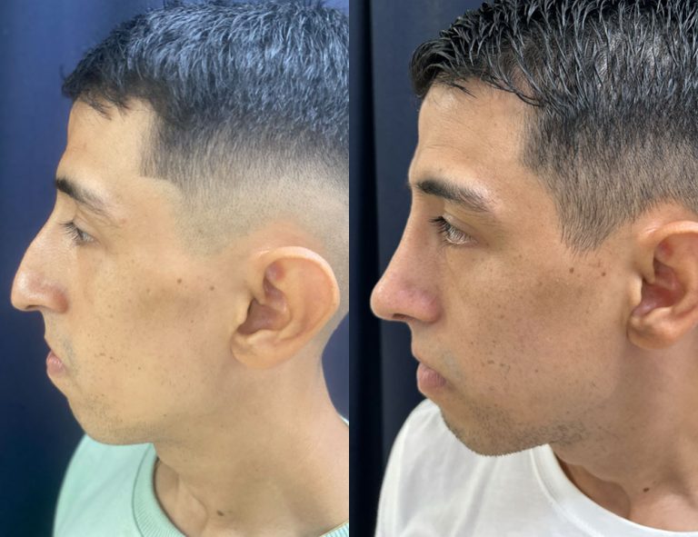 Post-operatorio (60 días)