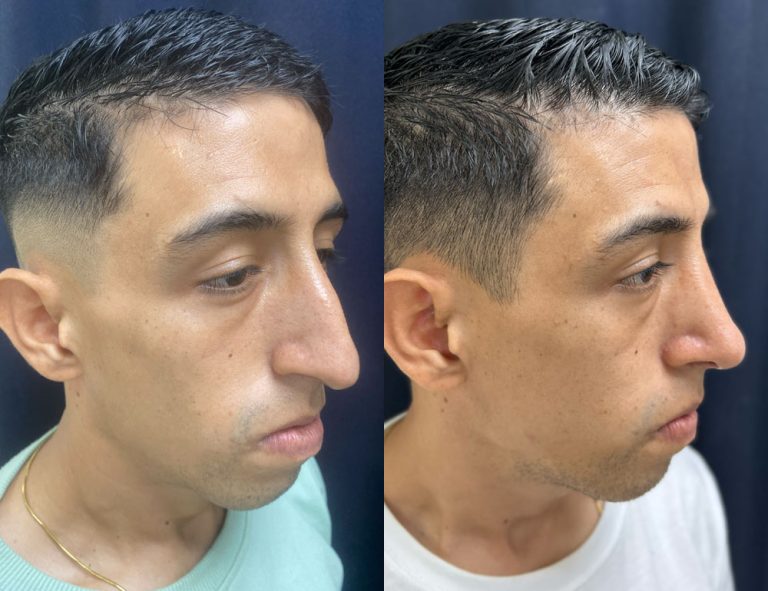 Post-operatorio (60 días)