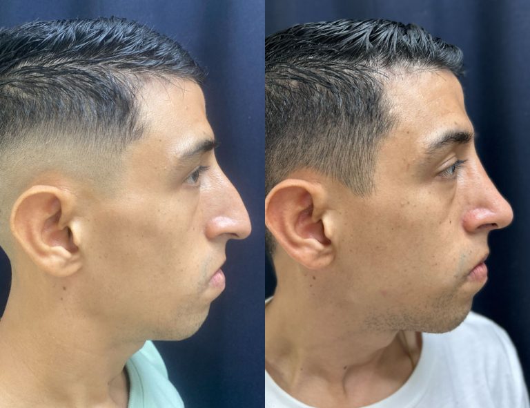 Post-operatorio (60 días)