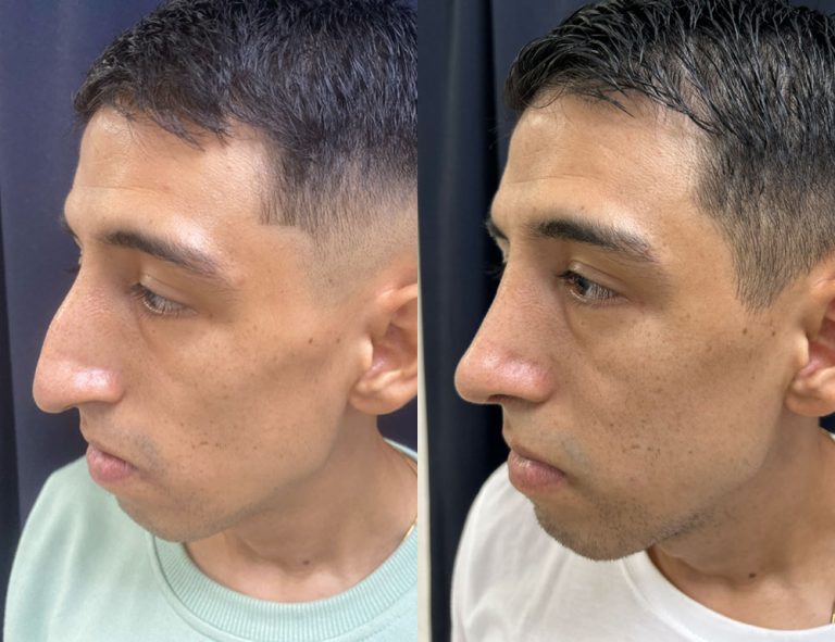 Post-operatorio (60 días)