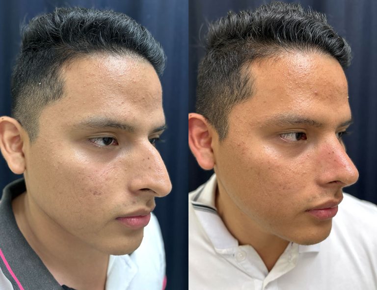 Post-operatorio (60 días)