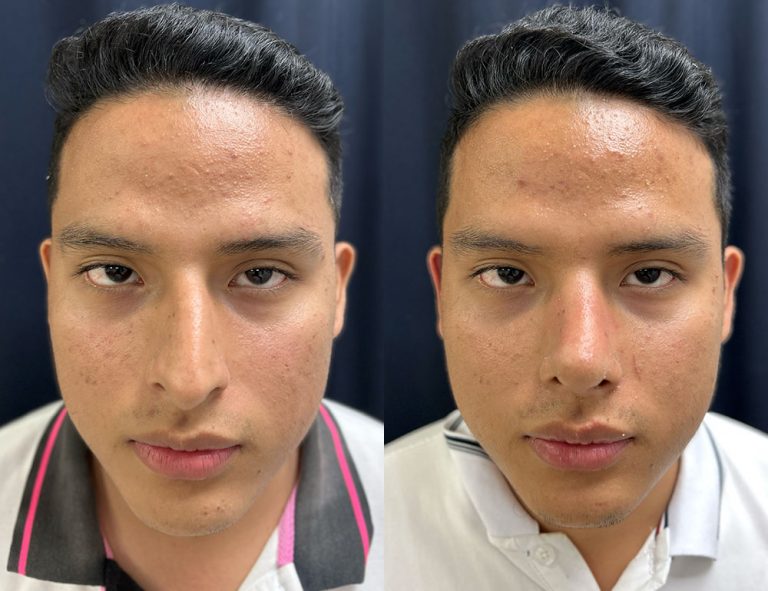 Post-operatorio (60 días)