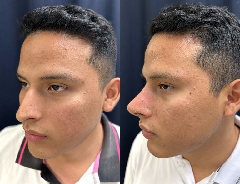 Post-operatorio (60 días)