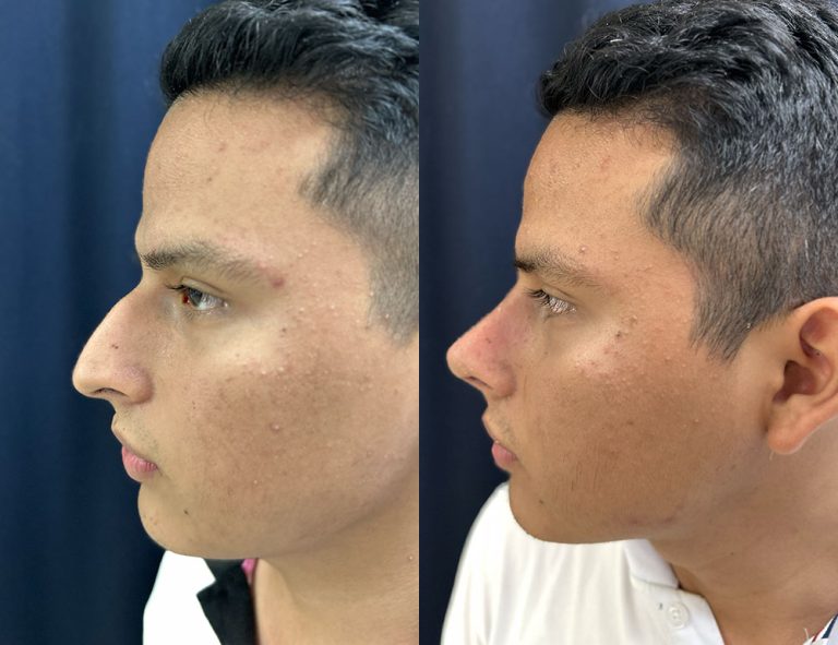 Post-operatorio (60 días)