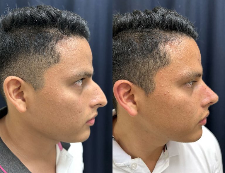 Post-operatorio (60 días)