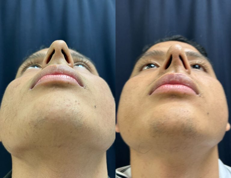 Post-operatorio (60 días)