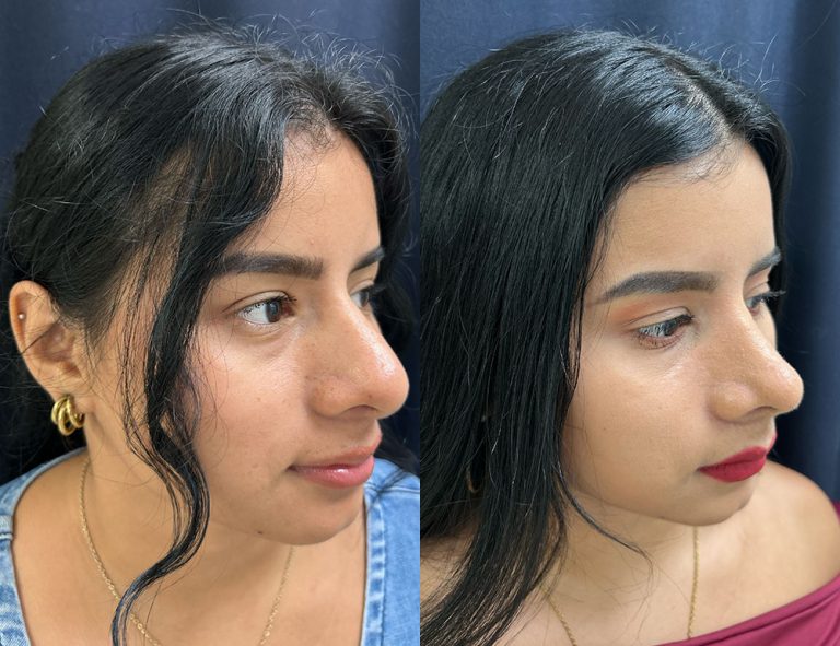 Post-operatorio (60 días)