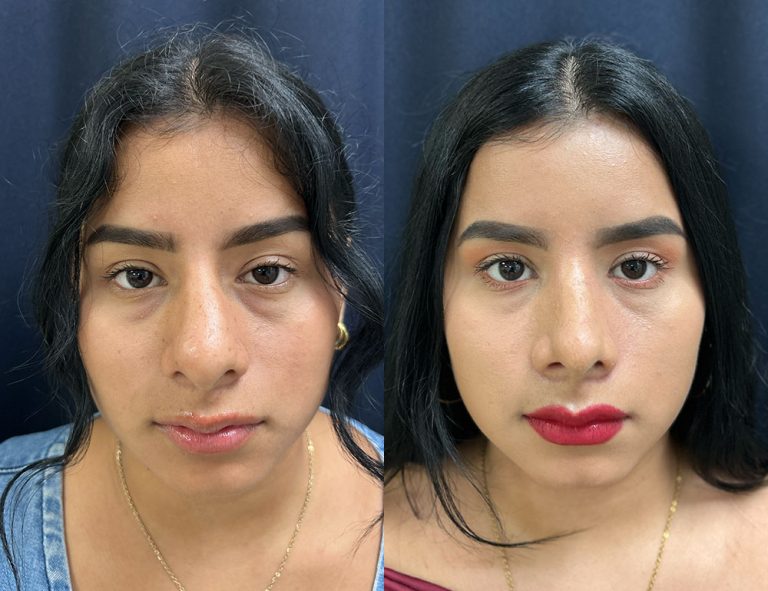 Post-operatorio (60 días)