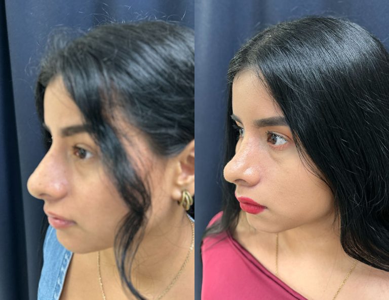 Post-operatorio (60 días)