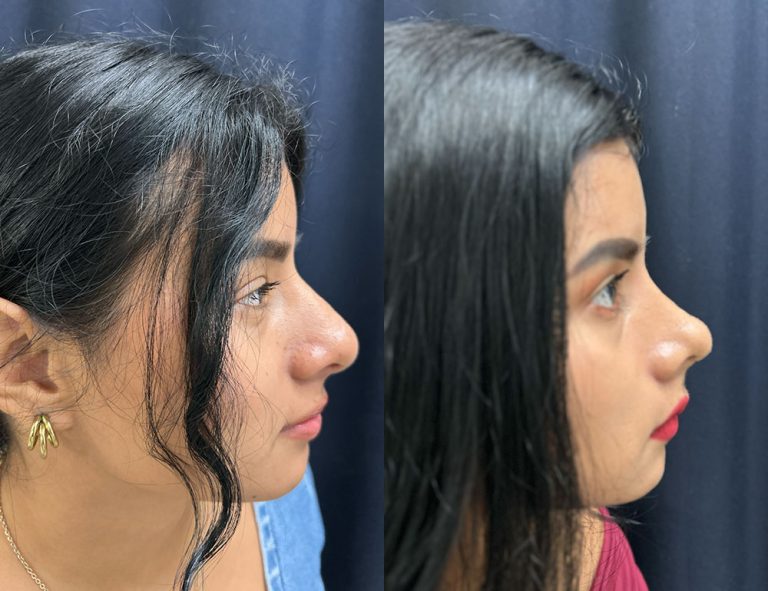 Post-operatorio (60 días)