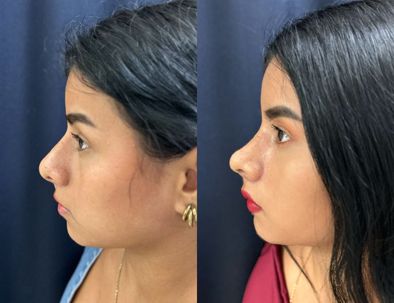 Post-operatorio (60 días)