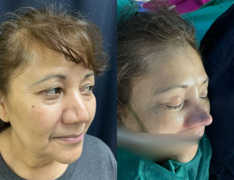 Post-operatorio inmediato