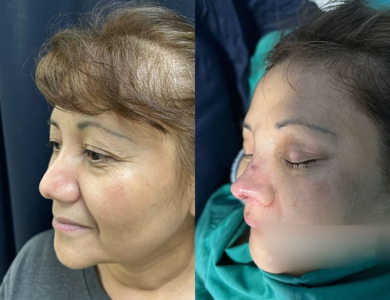 Post-operatorio inmediato