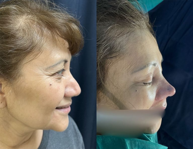 Post-operatorio inmediato