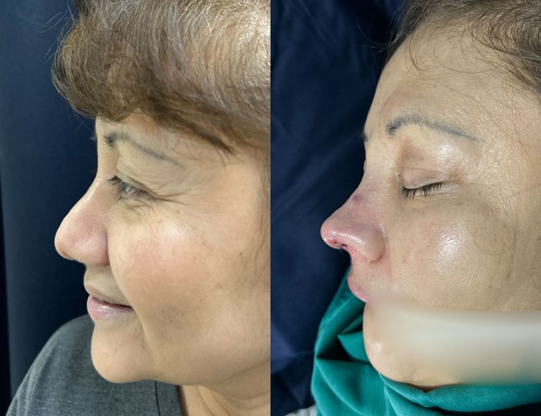 Post-operatorio inmediato