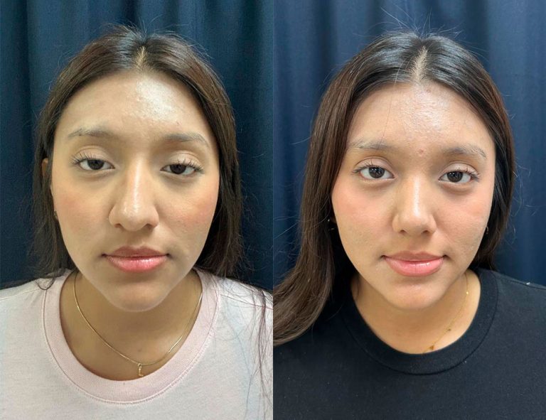 Post-operatorio 60 días