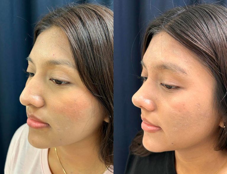 Post-operatorio 60 días