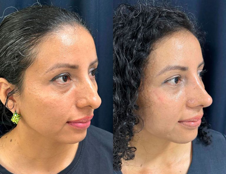 Post-operatorio 60 días