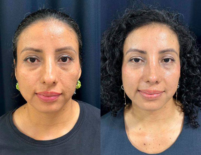 Post-operatorio 60 días