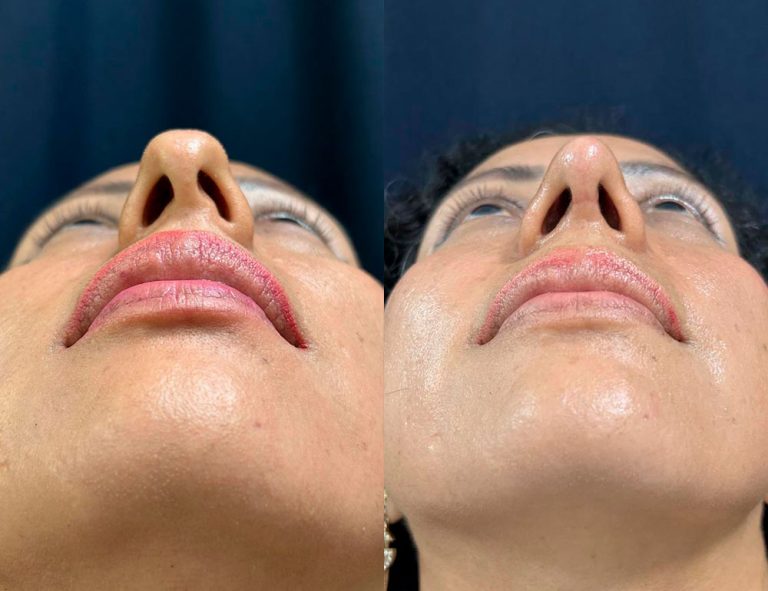 Post-operatorio 60 días