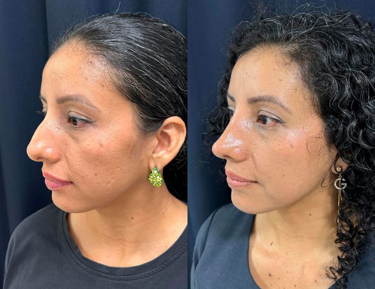 Post-operatorio 60 días