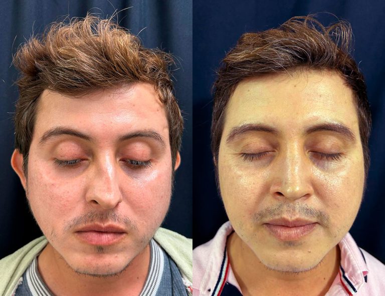 Post-operatorio 60 días