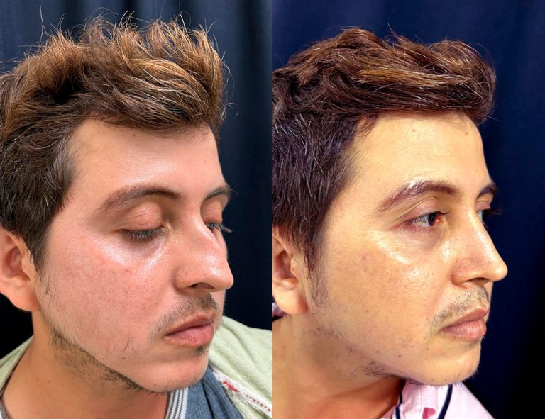 Post-operatorio 60 días