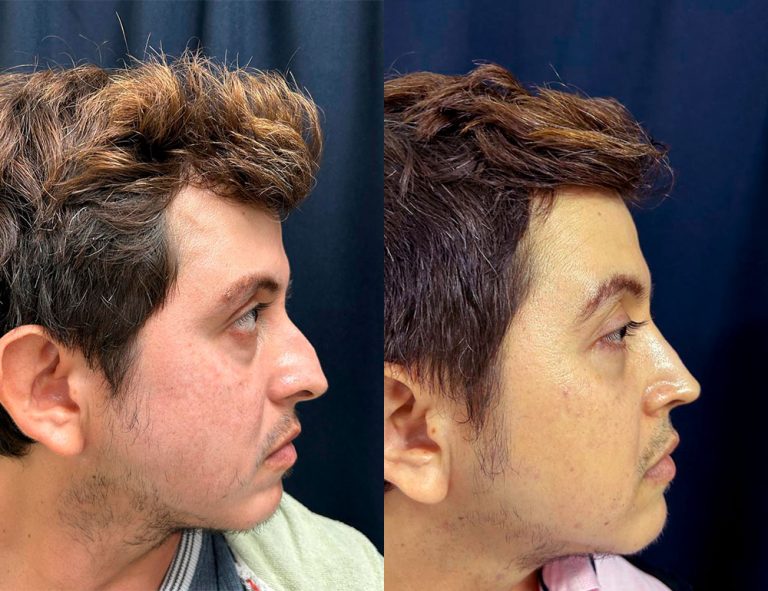 Post-operatorio 60 días