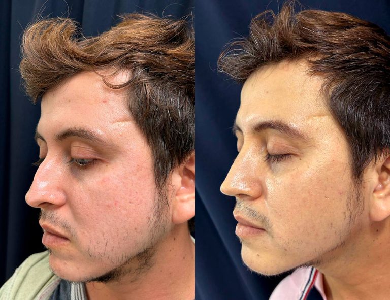 Post-operatorio 60 días