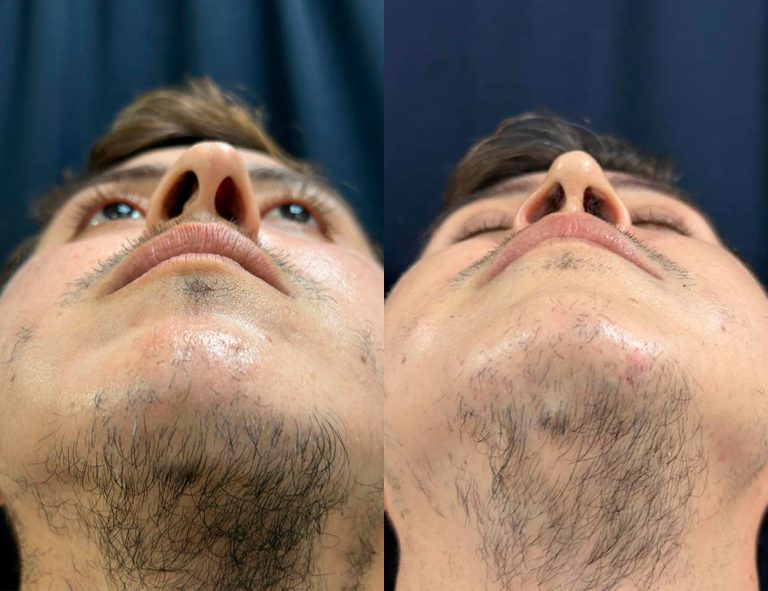 Post-operatorio 60 días