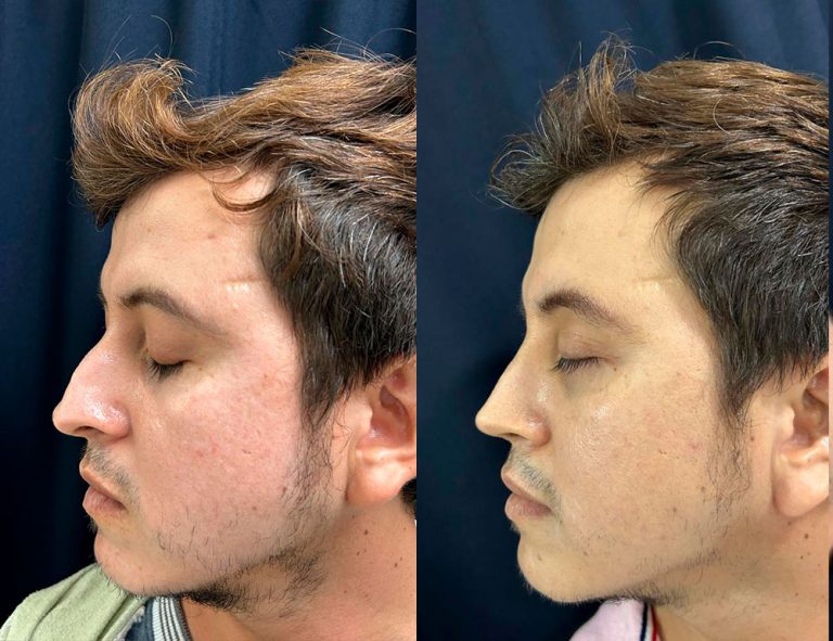 Post-operatorio 60 días